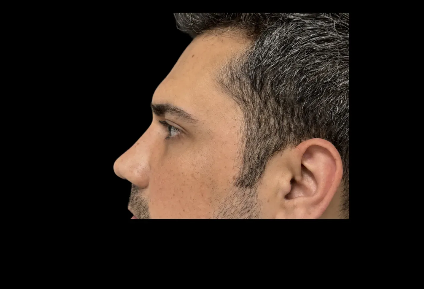 Burun Estetiği — Sonrası